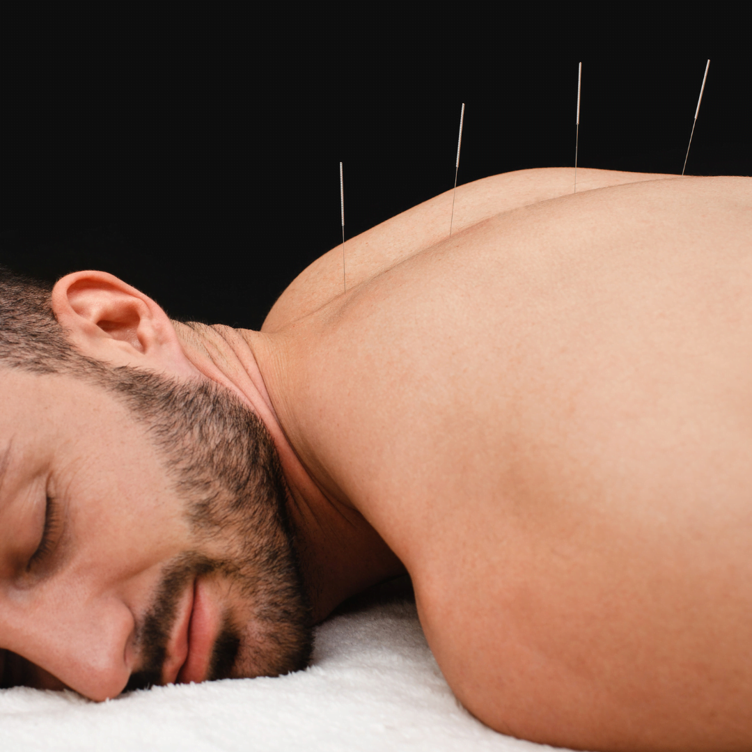 Acupunture | Southampton | YOU Massage Therapy